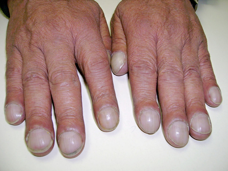 Dấu hiệu ung thư phổi ở bệnh nhân có ngón tay dùi trống